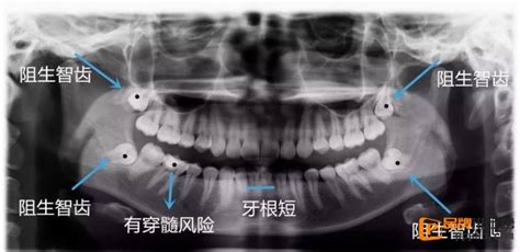 如何判断自己长智齿了，手摸一下就能知道（三种方法） — 品牌排行榜