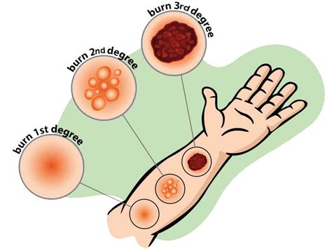 First Aid Chemical Burns