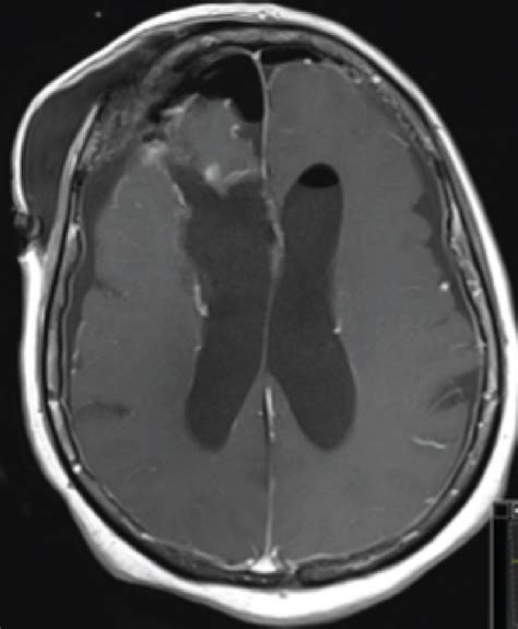 Postoperative Axial View Of A T2 And T1 With Contrast Weighted Images