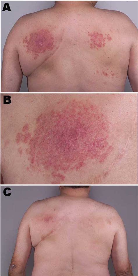 Figure - Mycobacterium intermedium Granulomatous Dermatitis from Hot ...