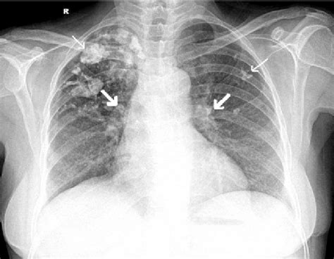 Chest Radiograph Postero Anterior View Showing Coarse Calcifications