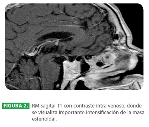 Tumor Carcinoide Del Seno Esfenoidal Una LocalizaciÃ Æ Ã