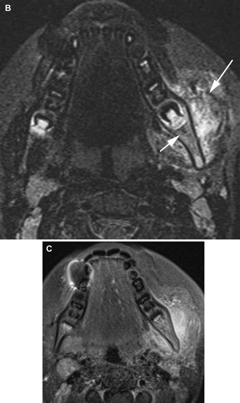 Pediatric Chronic Nonbacterial Osteomyelitis Of The Jaw Clinical