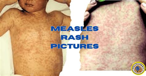 Measles Causes Symptoms And Effective Treatments