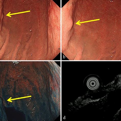 Ster Procedure For The Resection Of Esophageal Leiomyoma A