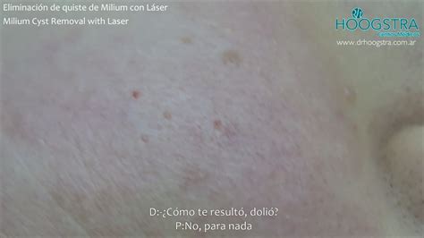 Milium Cyst Treatment Hoogstra Medical Centers