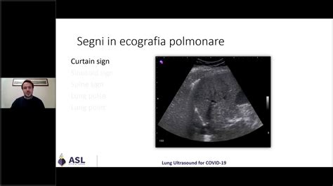 Ecografia Polmonare Per Le Usca Segni Youtube