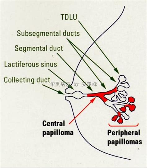 乳腺导管内乳头状癌 搜狗百科