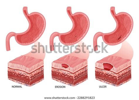 Stomach Erosion Ulcer Development Vector Illustration Stock Vector