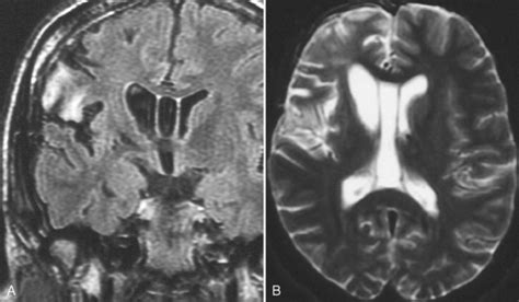 Infectious And Noninfectious Inflammatory Diseases Of The Brain