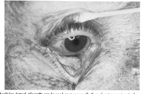 Figure 5 from Management of Cosmetic Eyelid Surgery Complications ...