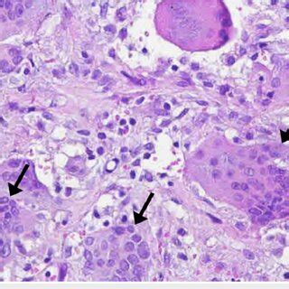 Hematoxylin And Eosin Section Showing Multinucleated Giant Cells