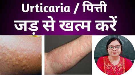 Hives Urticaria Pitti एलर्जी की दवा Homeopathic Treatment For