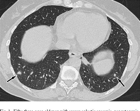 Figure 1 From Initial Ct Manifestations Of Invasive Pulmonary Aspergillosis In 45 Non Hiv