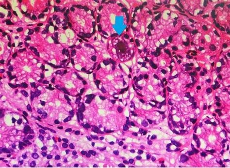 Hematoxylin And Eosin H E Staining Of Gastric Antral Biopsy Showing