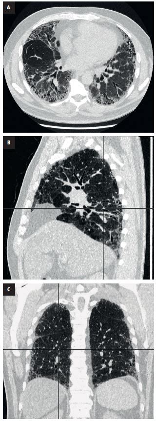 Gu As Ats Y Ers Diagn Stico De La Fibrosis Pulmonar Idiop Tica