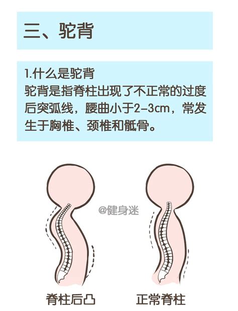 弯腰驼背怎么纠正弯腰驼背驼背第6页大山谷图库