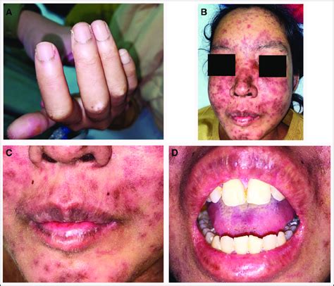 The Extraoral Conditions A Sclerodactyly B Multiple Brownish Red