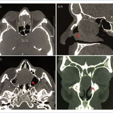 Nasopharyngeal Endoscopic Image (S; septum, T; left torus tubarius, M;... | Download Scientific ...