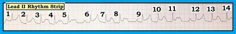 ECG Interpretation: ECG Interpretation Review #55 (Mobitz I - Mobitz II ...