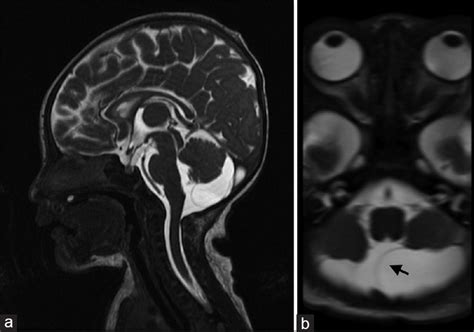 Arachnoid Cyst Posterior Fossa