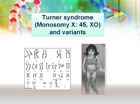 Medical Genetics Klinefelter Turner Down Syndrome Reproductive Block