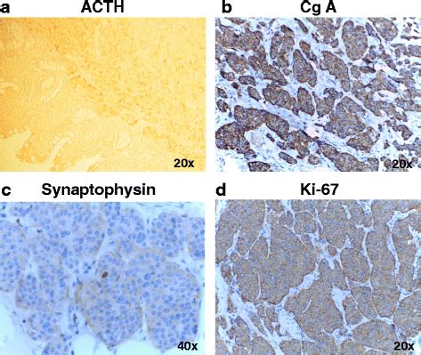 Tumoral Positive Immunostaining For Acth A Cga B Synaptophysin