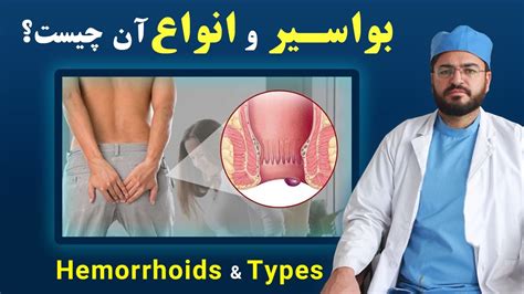 بواسیر چیست و انواع بواسیر چیست؟ داکترستان What Is Hemorrhoid And Types