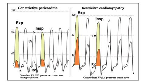 Constrictive Vs Restrictive Cardiomyopathy Dr S Venkatesan Md