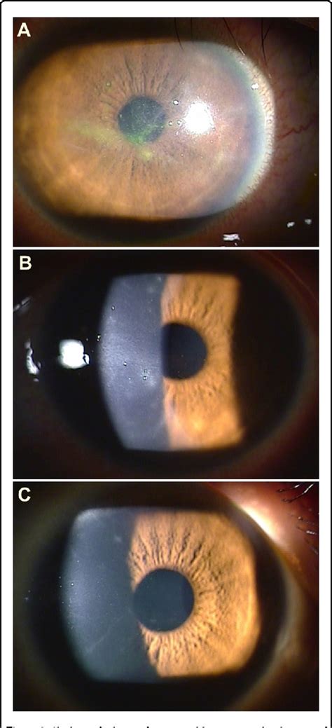 Figure 1 From A Case Of Atypical Acanthamoeba Keratitis With Cruciate Stromal Infiltration