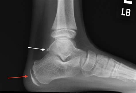 Calcaneus Back of Heel Pain - Orange County Pediatric and Sports Medicine Practice