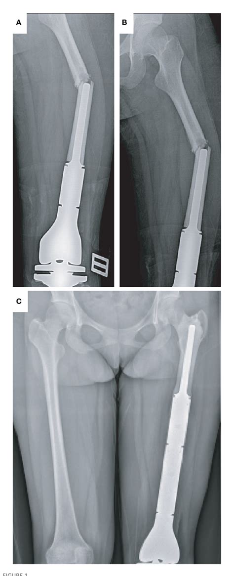 Figure From Revision Surgery For Periprosthetic Fracture Of Distal