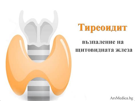 Какви видове тиреоидити има? | ArsMedica.bg