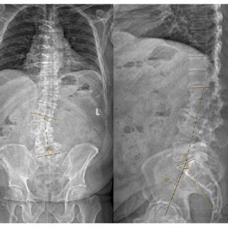 Anteroposterior And Lateral Radiographs Show Lumbar Spondylosis A