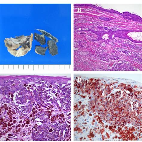 Gross And Histologic Features Of The Ovarian Cystic Mass A Dermoid