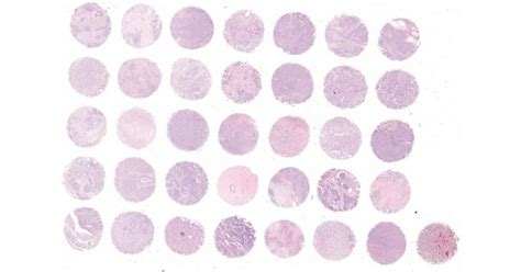 Br351a Poorly Differentiated Breast Cancer Tissue Array Including Tnm