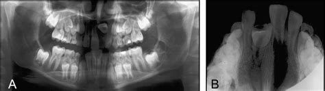 Figure 3 From Treatment Of An Impacted Dilacerated Maxillary Central