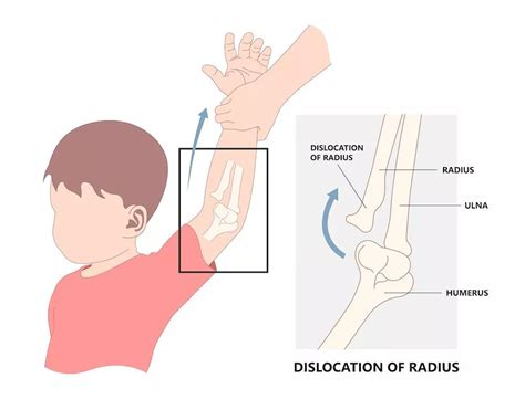 Effective Treatment of Nursemaid Elbow: Techniques and Recovery ...