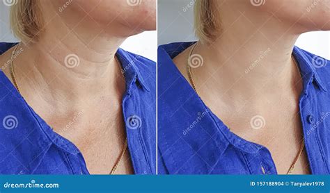 Woman Neck Wrinkles before after Treatment Stock Photo - Image of chin ...