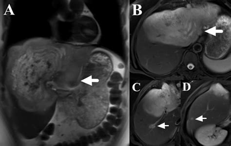 Frontiers Sirolimus Combined With Interferon Alpha B Therapy For