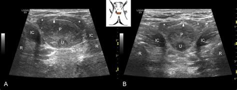 Transperineal Sonography Evaluation Of Muscles And Vascularity In The