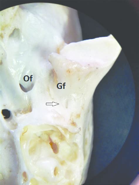 Left Basicranium In Ventral View Depicting The Fused Spine Of The