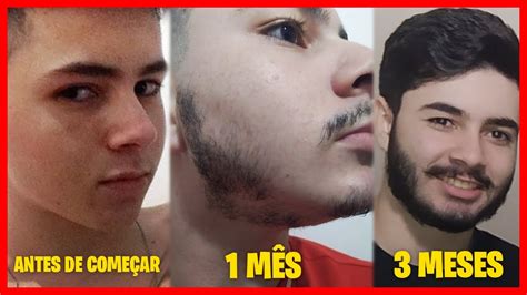 Timelapse Minoxidil Resultado Barba Antes E Depois Youtube