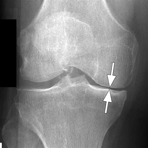 State Of The Art Imaging Of Osteoarthritis—revisited 2020 Radiology