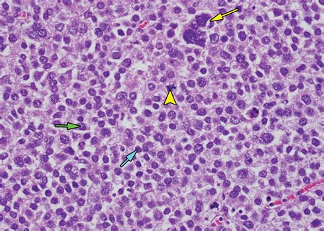 Testicular Seminoma And Its Mimics From The Radiologic Pathology