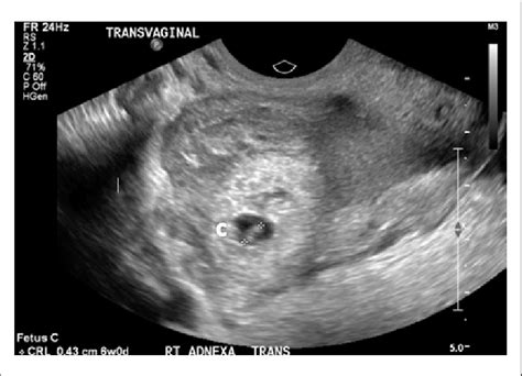 6 Weeks Ectopic Pregnancy Ultrasound