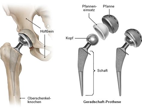 Hüft Endoprothese