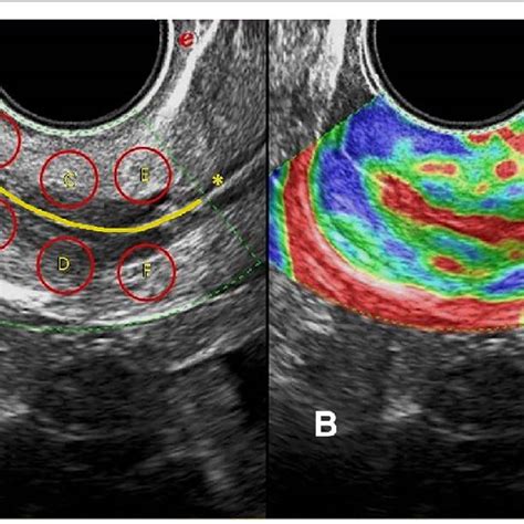 Cervical Elastography A Identification Of Six Regions Of Interest