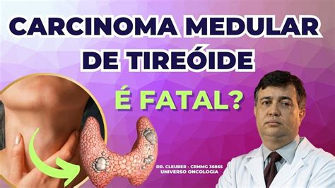 O Que Causa Alteração Na Tireoide - Ndulo Na Tireoide O Que Sintomas Causa E Como