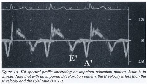 Pedi Cardiology Tissue Doppler Imaging Mitral Lateral Annulus TDI